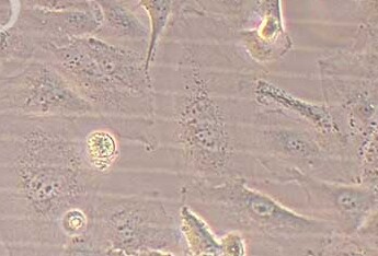 人肝癌细胞系SNU-475 Human liver cancer cell line SNU-475