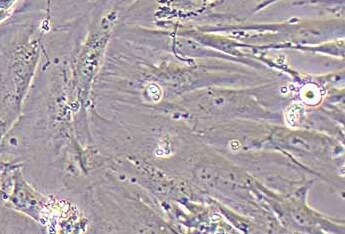 人子宫内膜异位症患者在位内膜间质细胞永生化细胞hEM15A (STR鉴定正确)