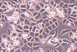 人转移胰腺腺癌细胞吉西他滨耐药株ASPC-1/GEM(STR鉴定正确)