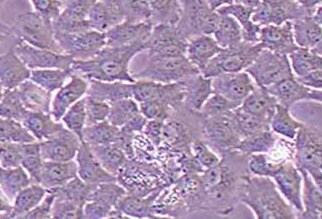 人肺腺癌耐顺铂株A549/DDP(STR鉴定正确) Human lung adenocarcinoma resistant to cisplatin strain A549/DDP