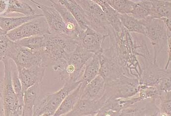 人瘢痕疙瘩成纤维细胞永生化 Immortality of human scar tissue fibroblasts