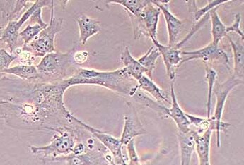 人卵巢癌相关成纤维细胞永生化 Immortality of human ovarian cancer-related fibroblasts