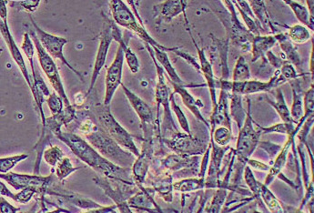 人胰腺肿瘤成纤维细胞永生化 Immortality of human pancreatic tumor fibroblasts