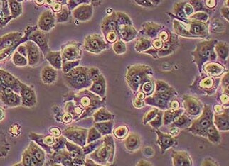 NCI-H2126 (人肺癌细胞系) (STR鉴定正确) NCI-H2126 (human lung cancer cells) (STR identification correct)