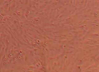 人髓核细胞(永生化细胞） Immortality of human nucleus pulposus cells