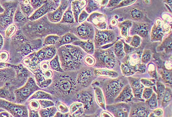 人卵巢癌组织源细胞(原代细胞) Human ovarian cancer tissue derived cells