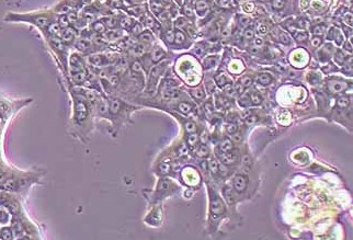 capan-1/GEM人胰腺癌吉西他滨耐药株 Capan-1/GEM human pancreatic cancer gemcitabine resistant strain