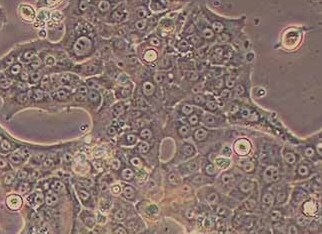 Capan-1-LUC人胰腺癌细胞(荧光示踪细胞) Capan-1-LUC human pancreatic cancer cells